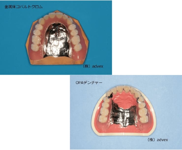 金属床義歯（コバルトクロム）