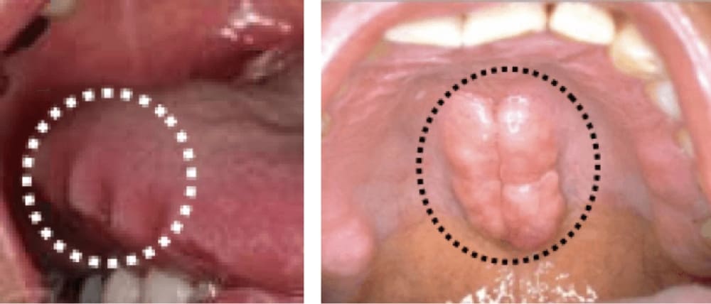 ②歯列接触癖（TCH）、歯ぎしり、くいしばり